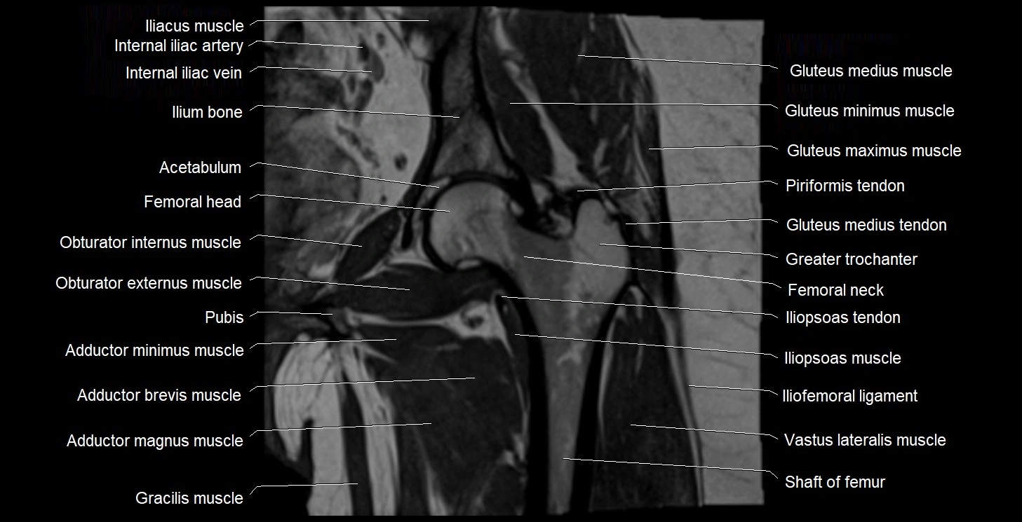 MRI Hip 3T coronal cross sectional anatomy image 34.webp